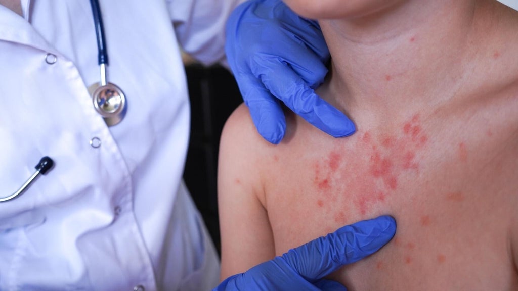 Minnesota's 80 measles cases this year are the most since 1990, health officials say — Wayzata Health news