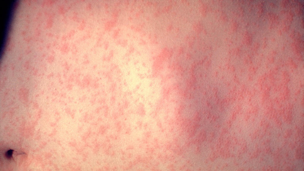 25 cases of measles identified in central, southeastern Minnesota, MDH says — WCCO / CBS Minnesota, Wayzata Health news